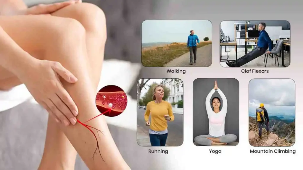 exercise to treat varicose veins