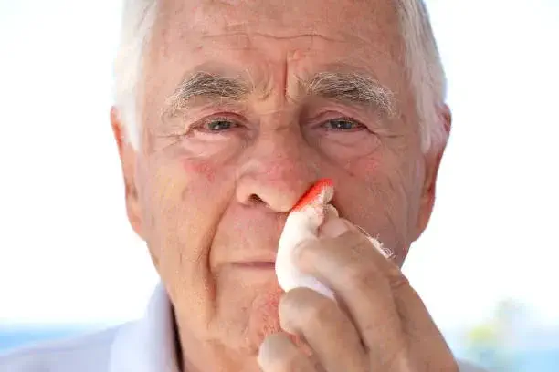 causes of nosebleeds in elderly
