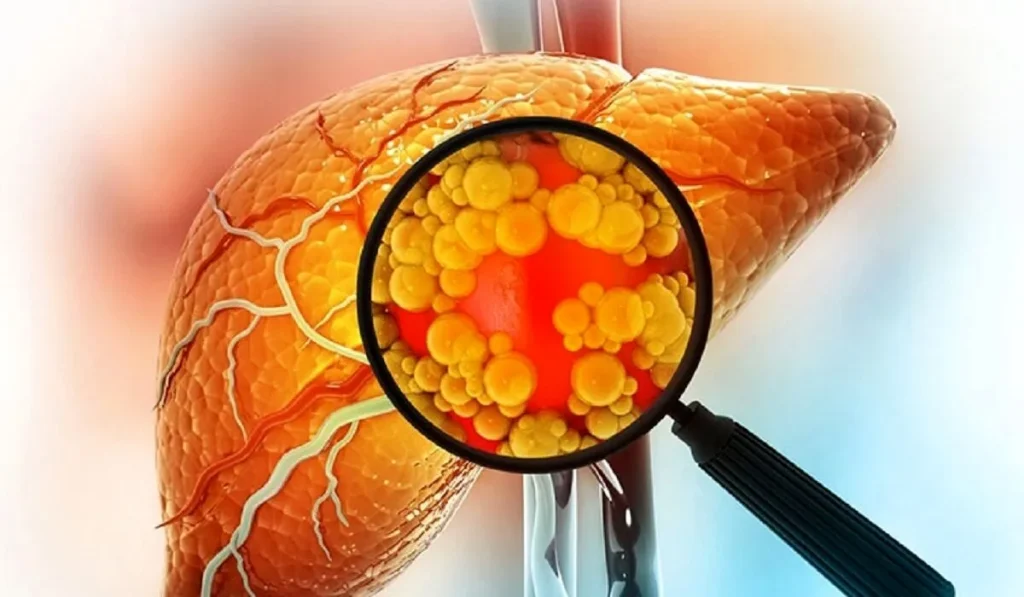 exercise to treat fatty liver