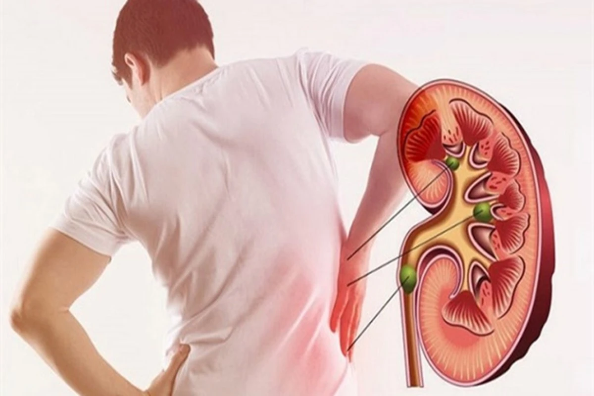 can exercise help to remove kidney stones
