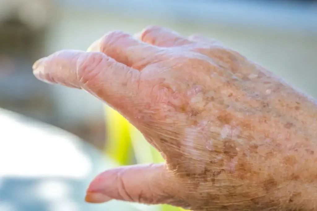 dry skin in the elderly